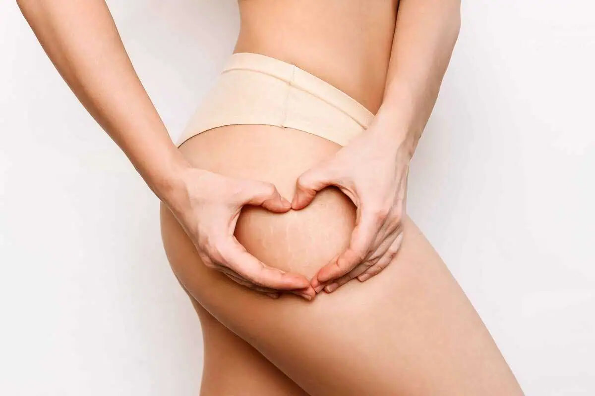 Red Light Therapy for Stretch Marks at Deeply Vital Medical