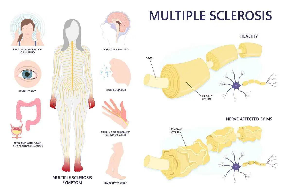 Can Red Light Therapy Help Multiple Sclerosis at Deeply Vital Medical